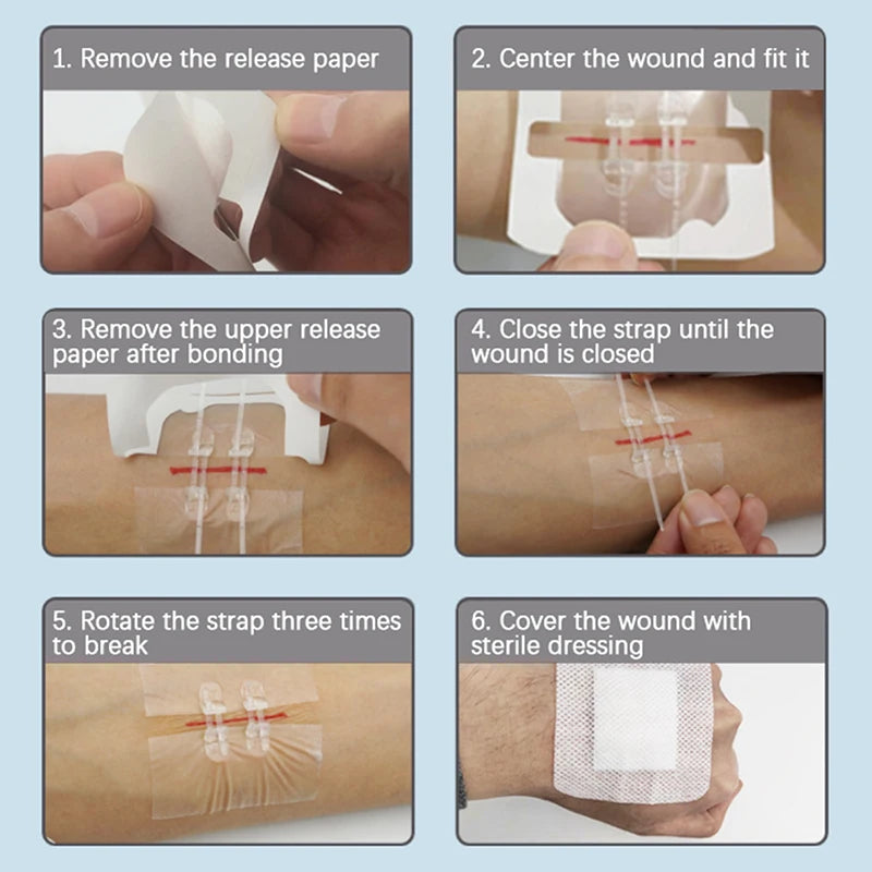 Camping Wound Closure Strips – Painless Adhesive Suture Patch for Fast ...
