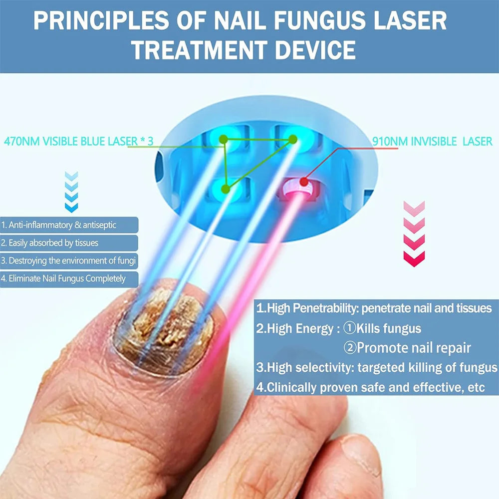 Nail Fungus Treatment Tools – Effective Anti-Fungal Equipment for Toen ...